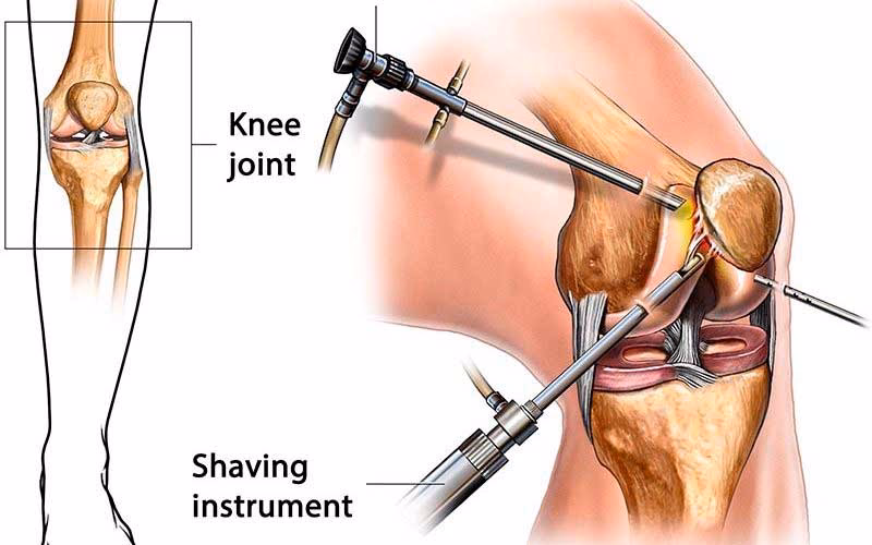 What is it called when they put a camera in your knee?