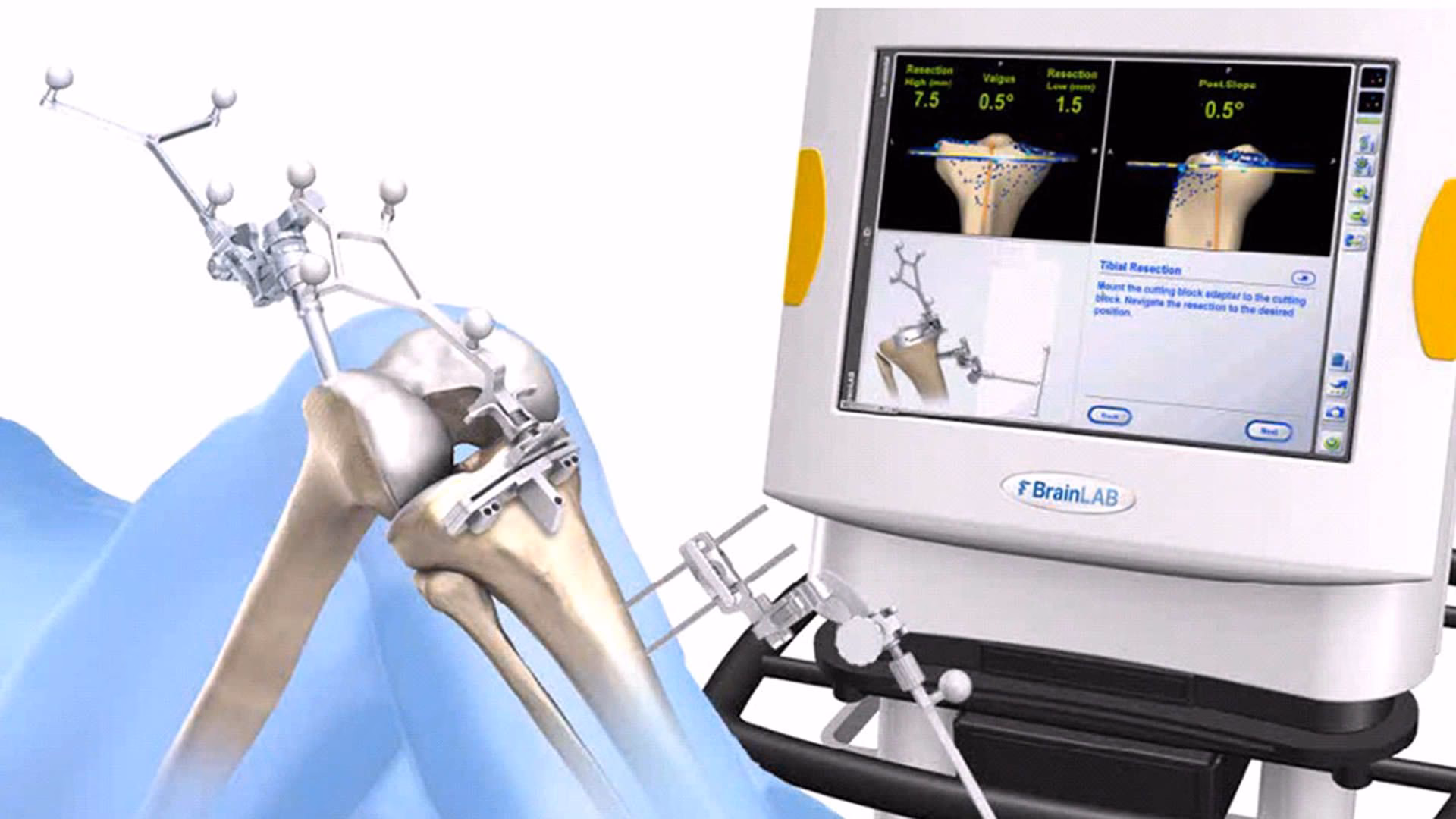 Ist eine Kniespiegelung sinnvoll oder nicht?